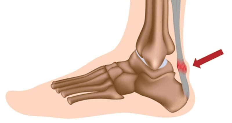 Image shows Achilles Tendinitis Illustration