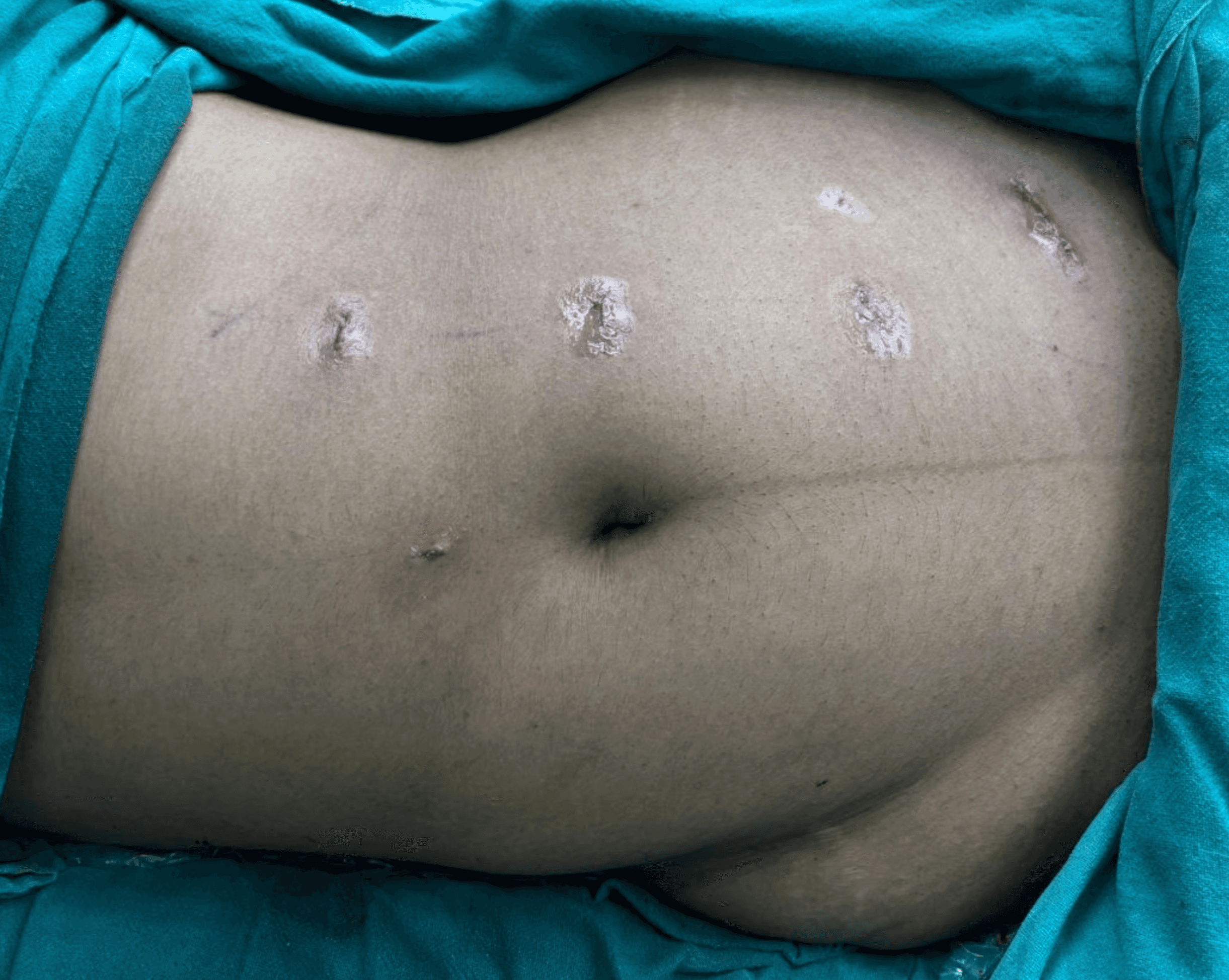 A close-up of a patient's abdomen showing small, healing keyhole incisions post-robotic surgery, demonstrating minimal scarring.
