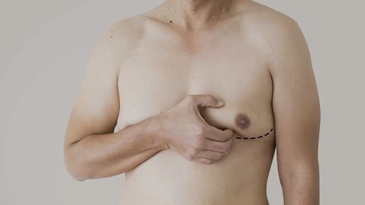 Gynecomastia