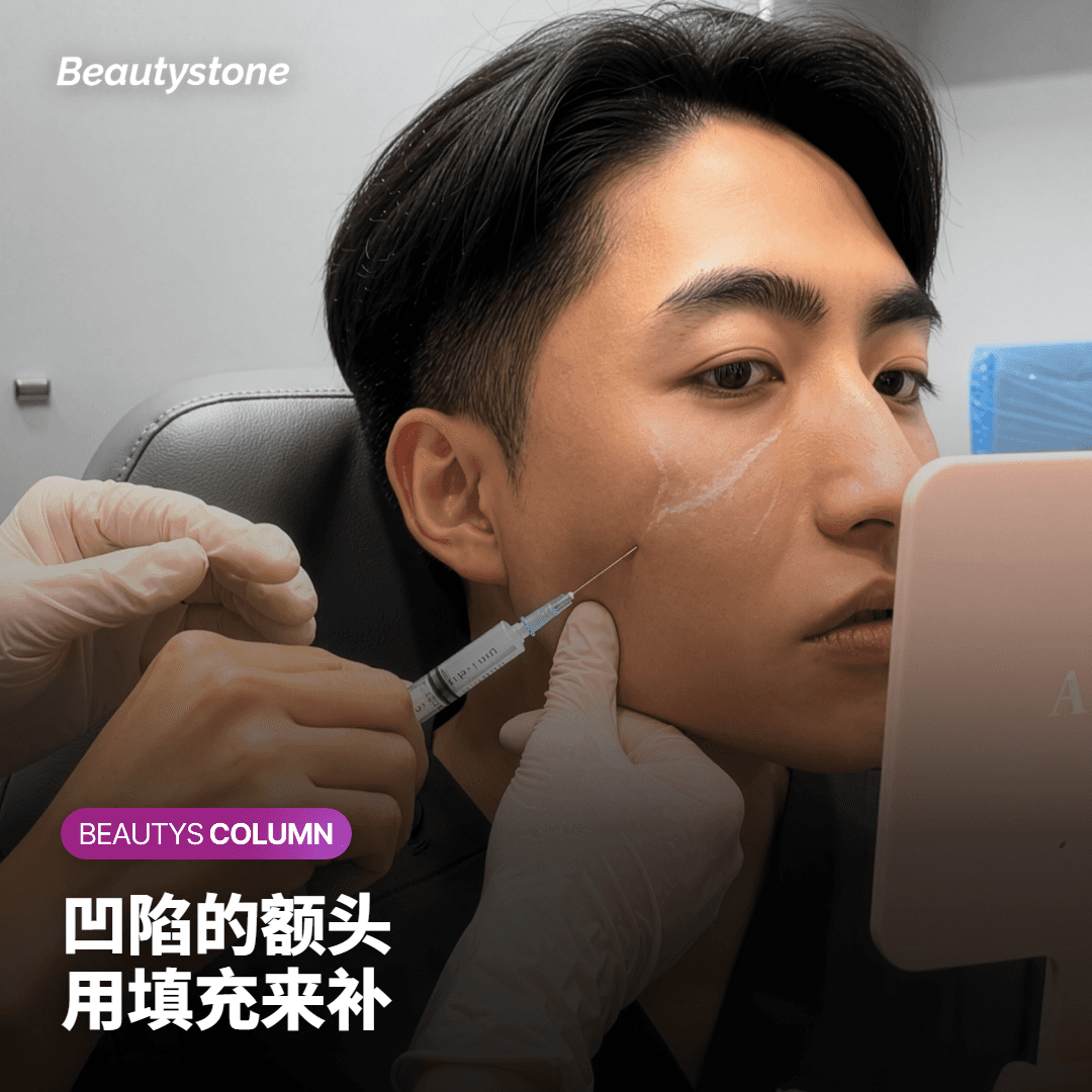 男士额头填充要打多少，效果能维持多久？