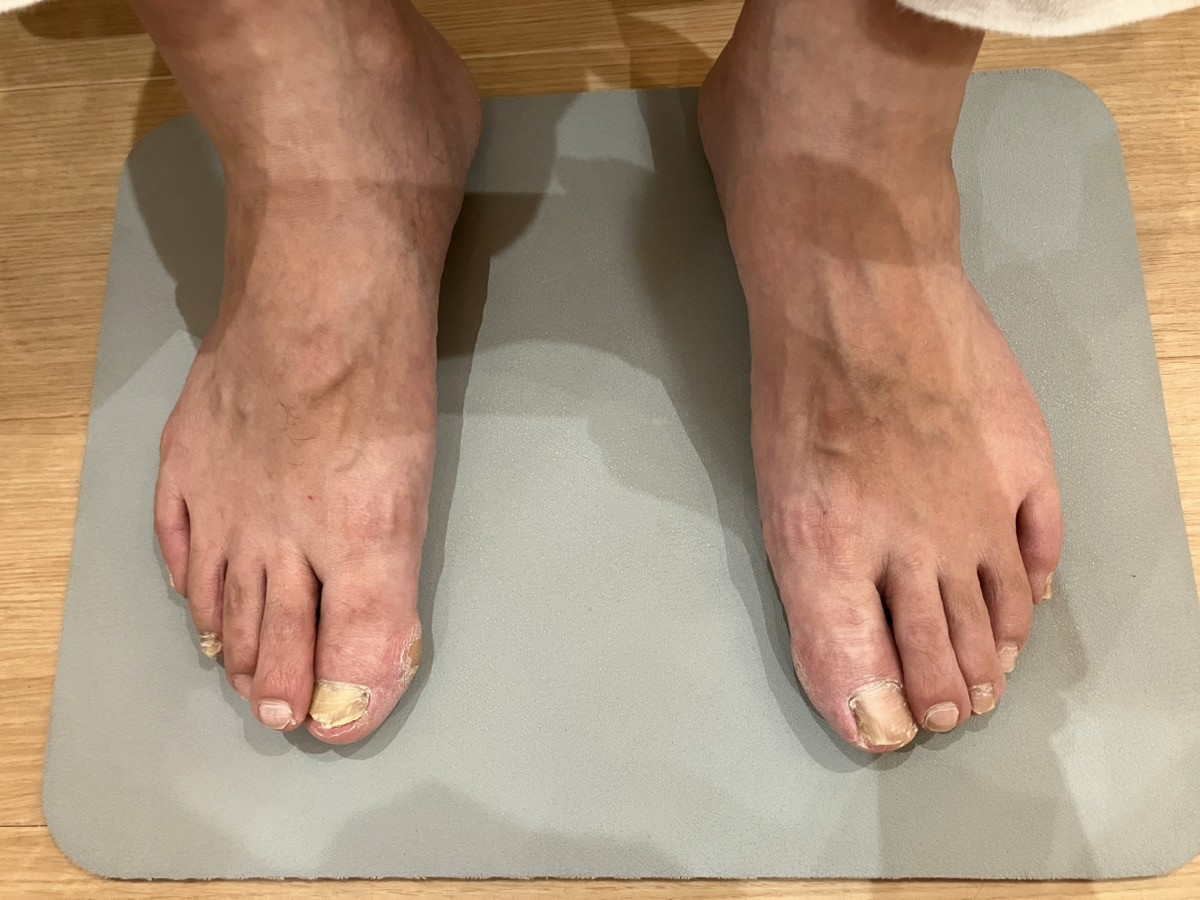 テーピング施術前