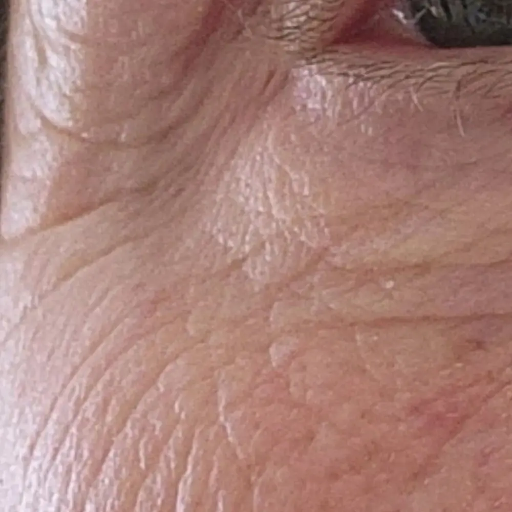 vancouver-aesthetician-hydrators-eye-area-wrinkles-hydrating-facial-series-before