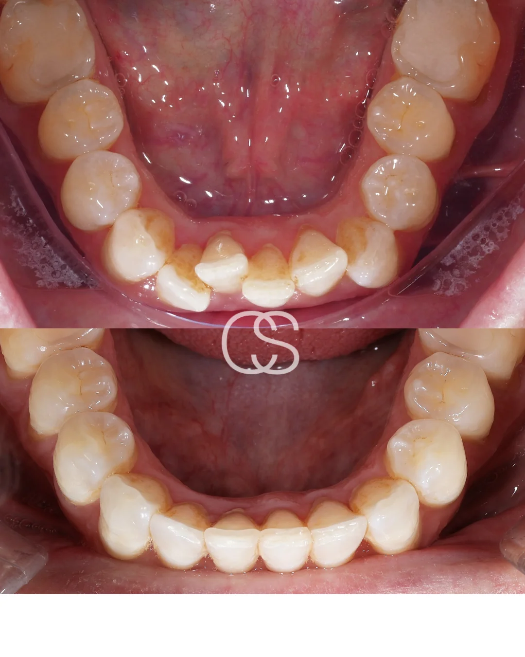 Before & After Braces at Colac Smiles, Colac