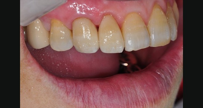 emax로 다색축성