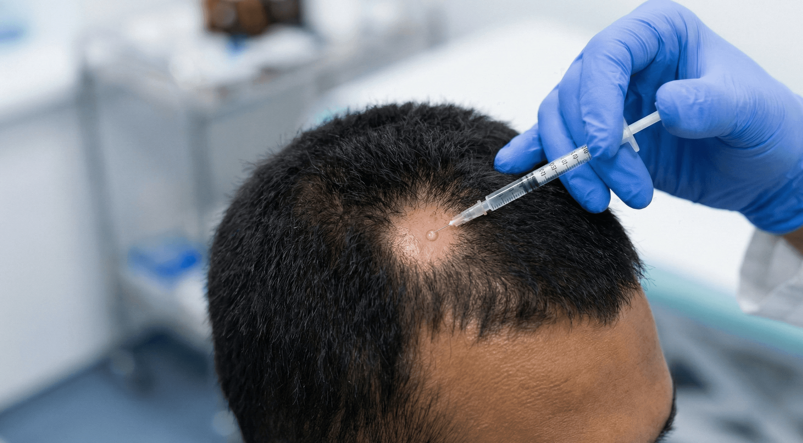 [A close-up of a clinician using a fine-gauge needle to perform a precise, superficial injection into a small, circular bald patch.]