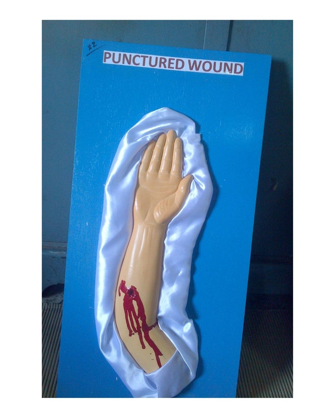 Punctured Wound (Arm)