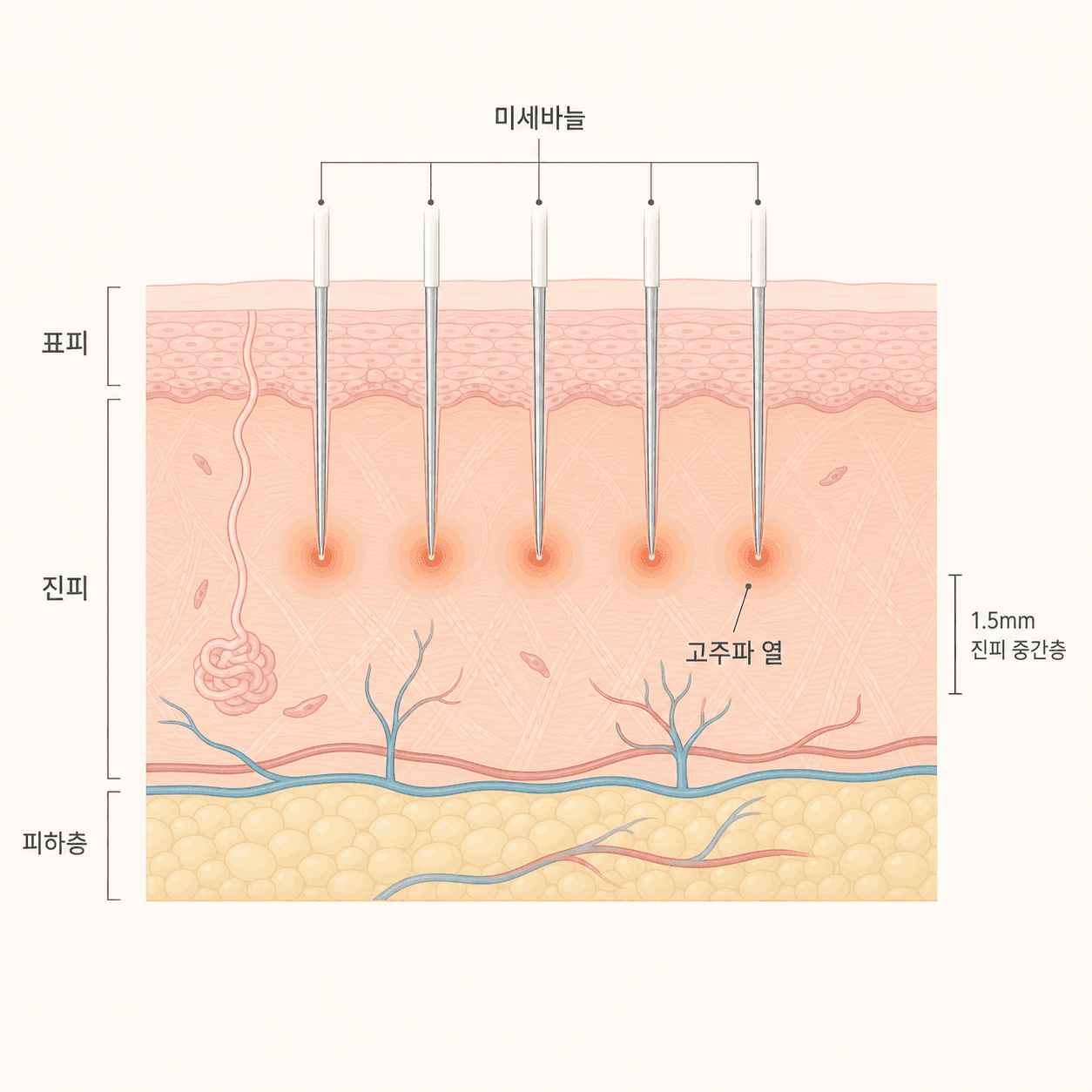미세바늘이 진피까지 들어가 고주파 열을 전달하는 구조