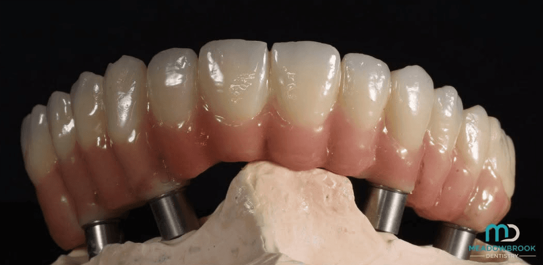 AOX implants