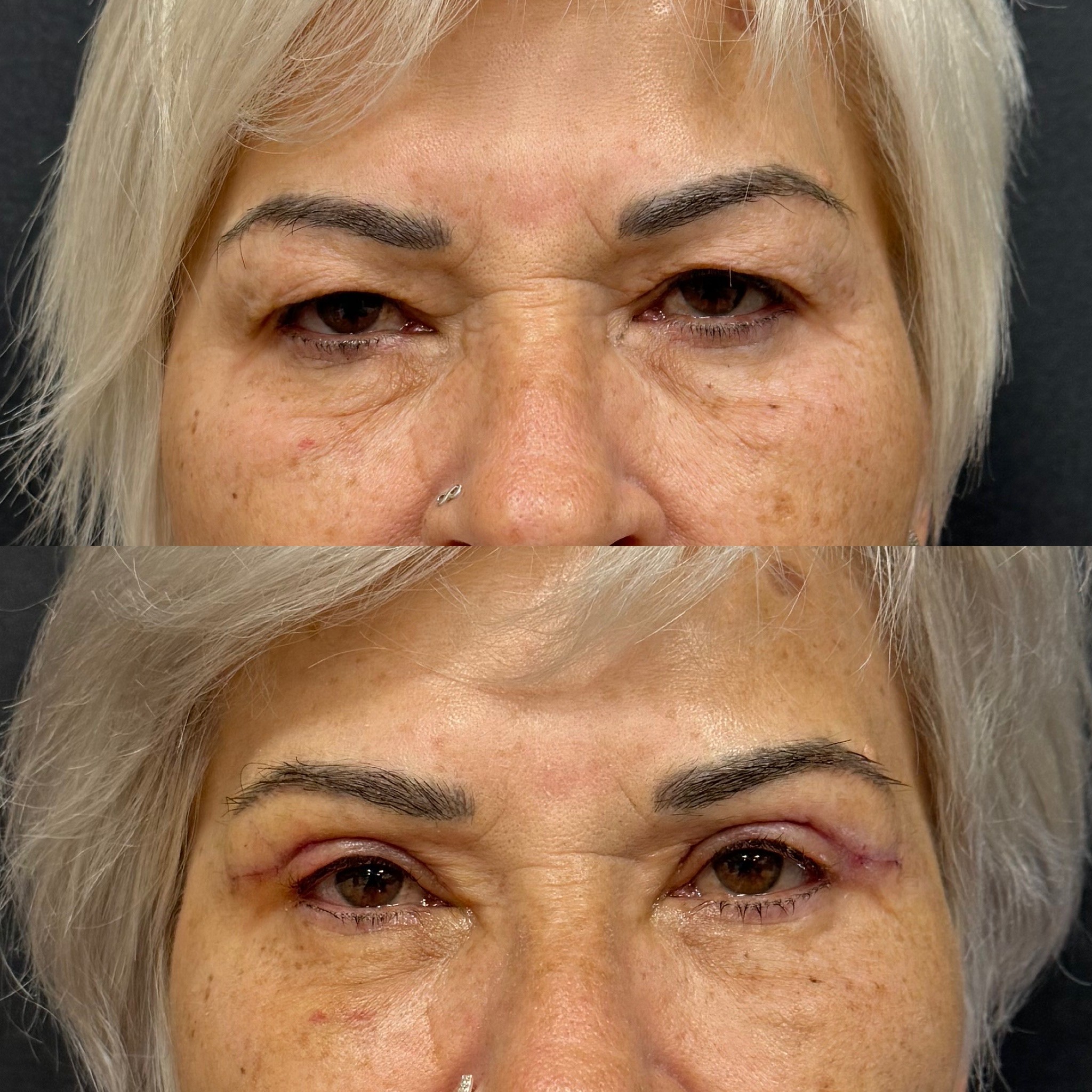 6 days upper blepharoplasty result front view