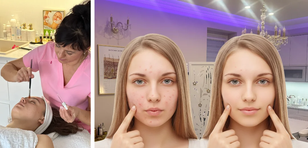 Jak zmniejszyc widocznosc blizn po tradziku - kobieta pokazująca trądzik na twarzy w gabinecie Belleza w Rzeszowie