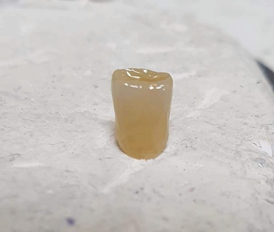 완성된 지르코니아 사진 