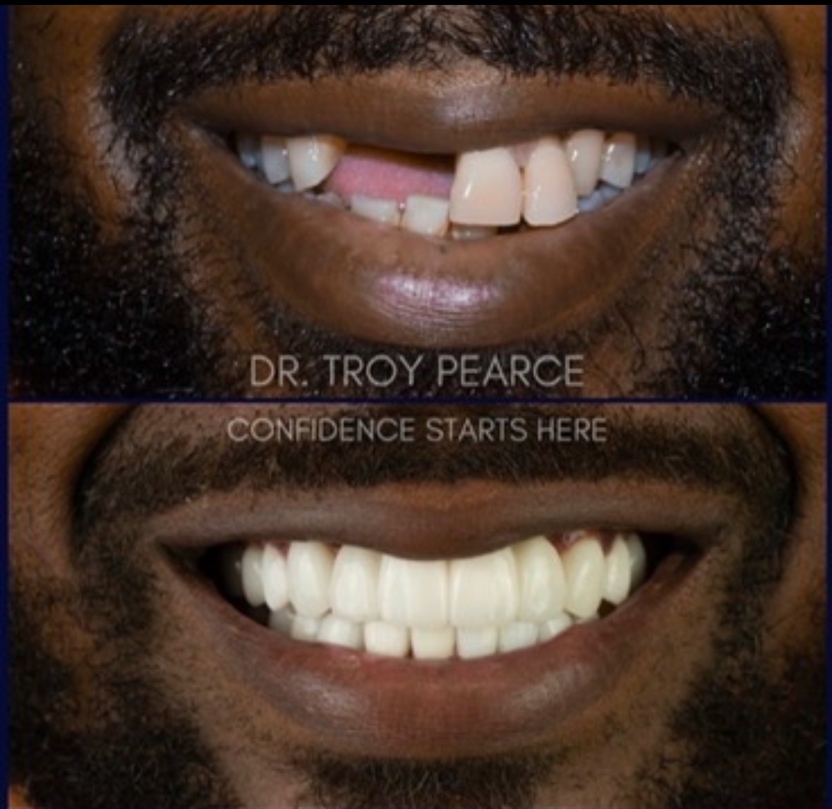 dummy teeth