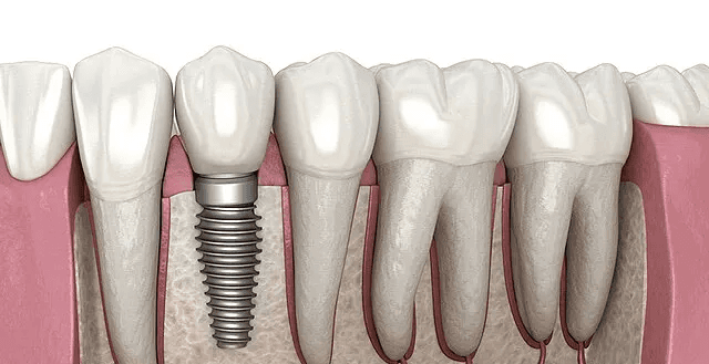 smyrna dental implants