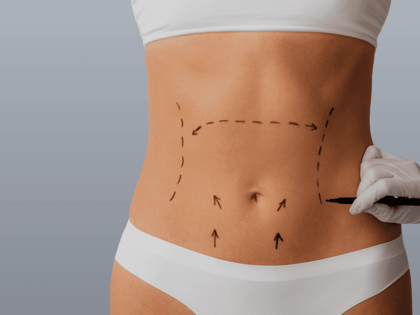 Abdominoplasty