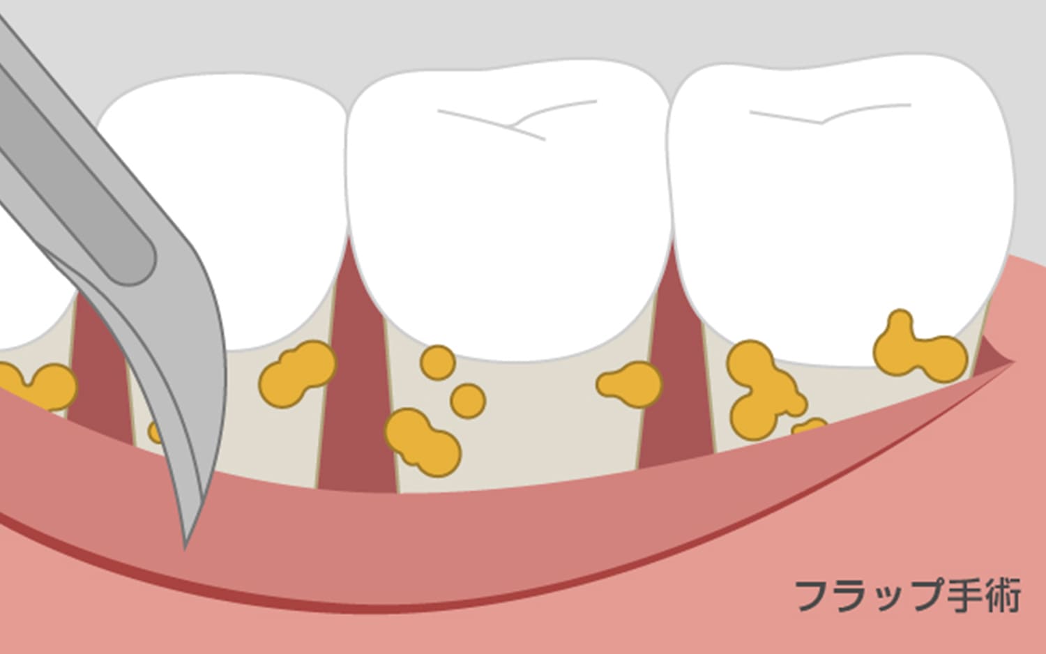 歯周病について