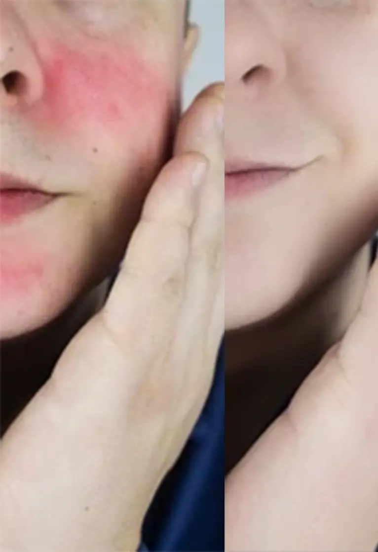 Before and after treatment - hand