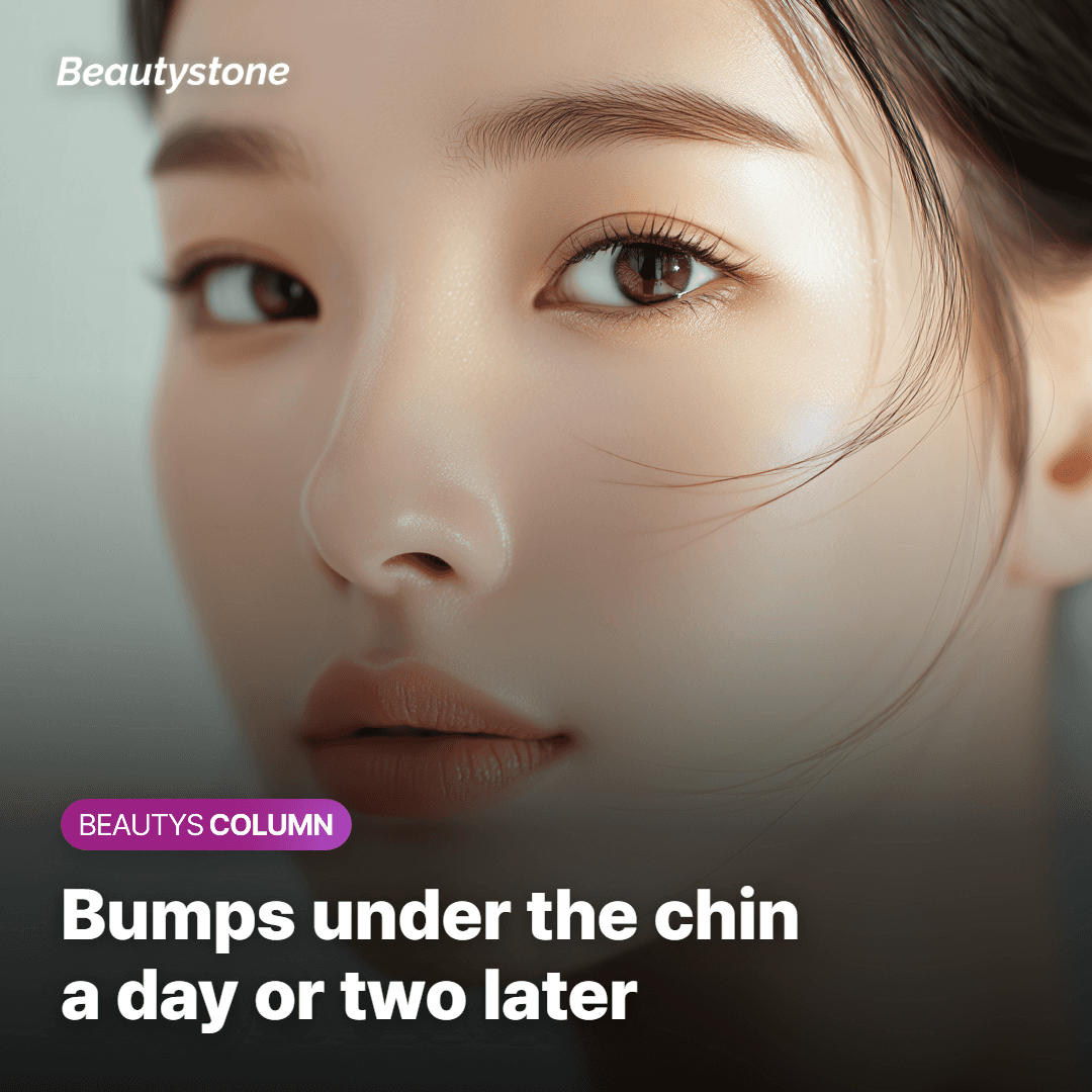 Beard folliculitis under the chin in the first days after laser hair removal