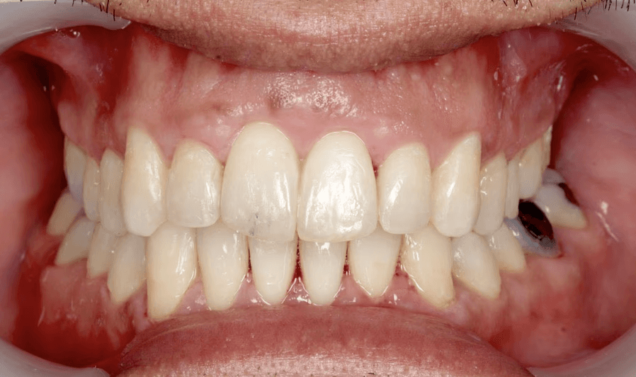 After clear aligner treatment showing improved tooth alignment