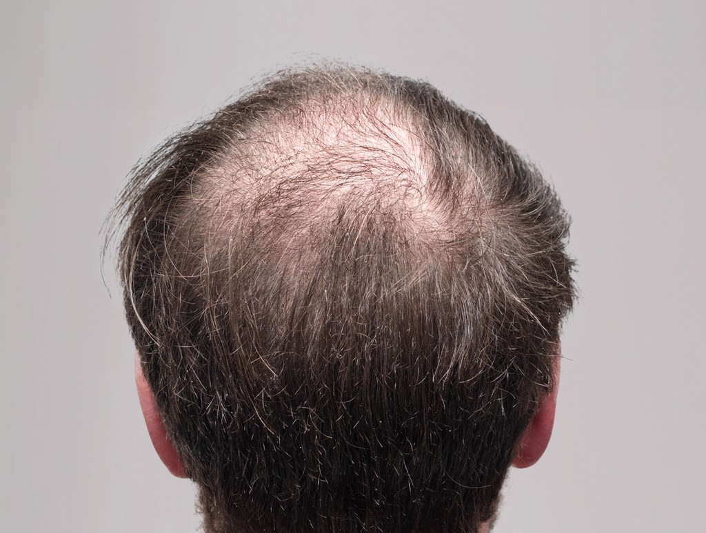 Male Pattern Baldness