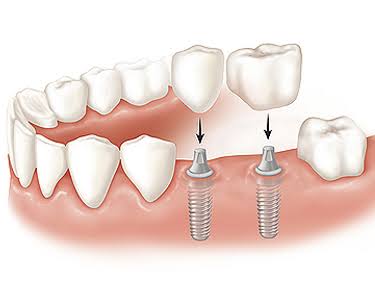 Patient placing a clear dental aligner over her teeth
