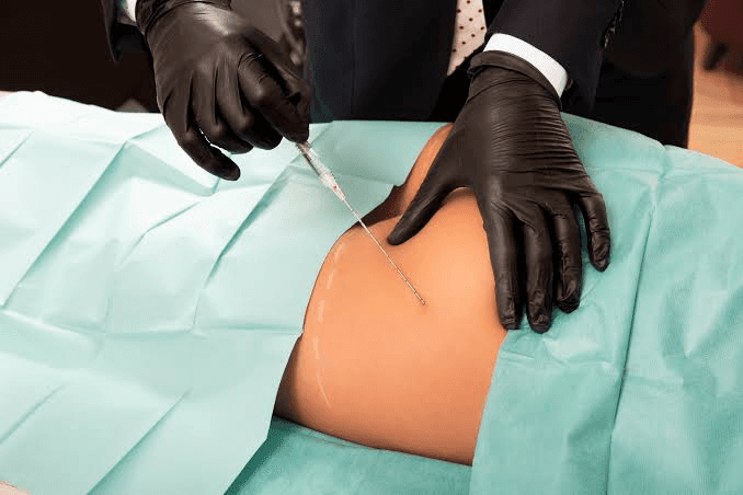 Are Buttock Fillers Safe? Evidence and Regulatory Status