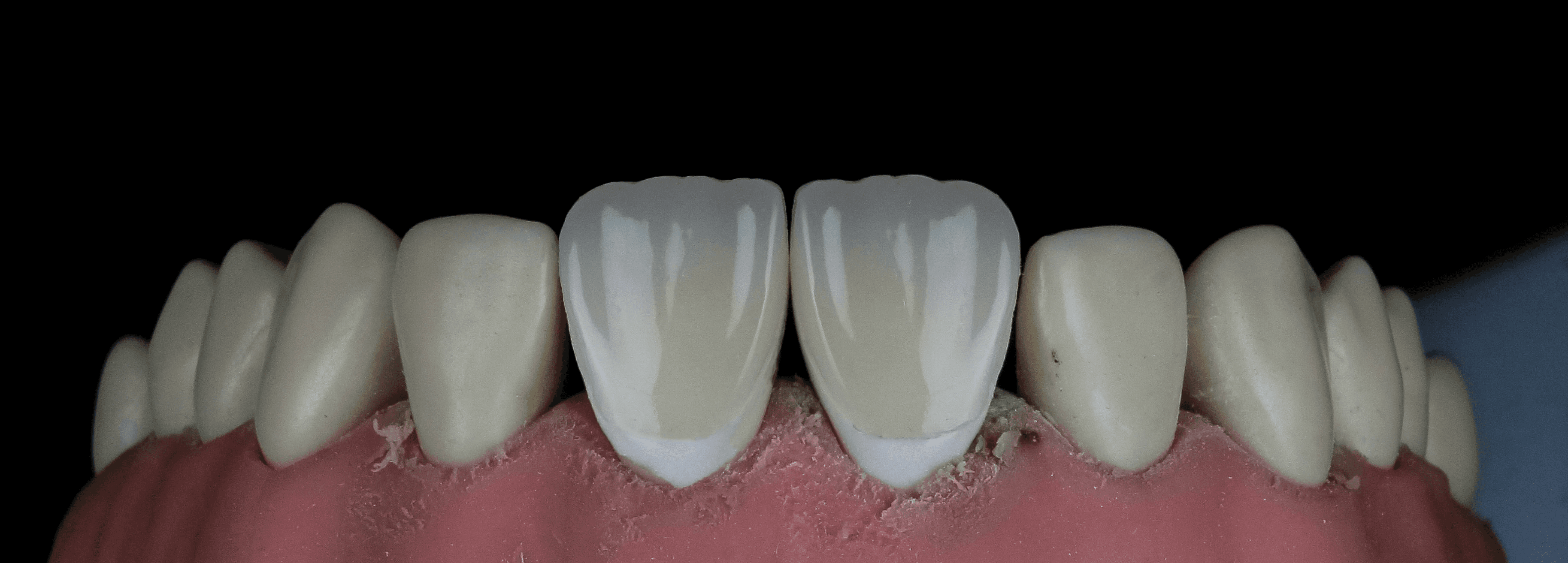 Veneers in Rochelle Park, NJ