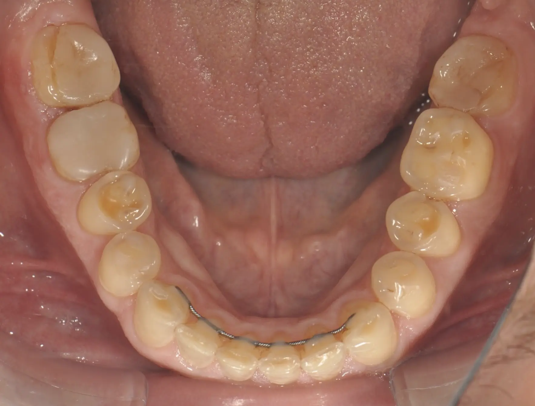 Mock-up of posterior teeth