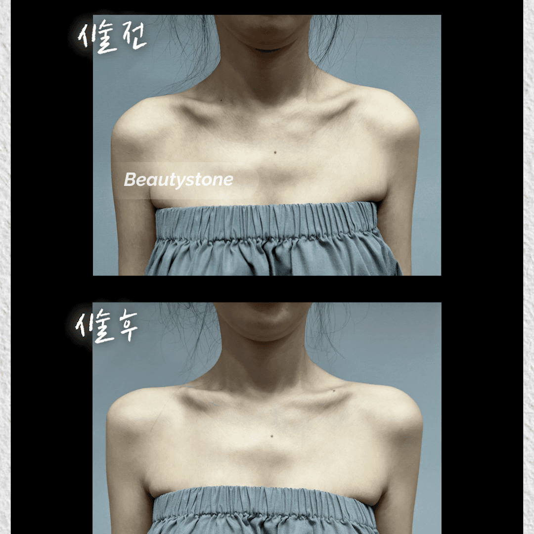 어깨필러 효과와 부작용, 직각 어깨 만드는 3가지 핵심 원칙