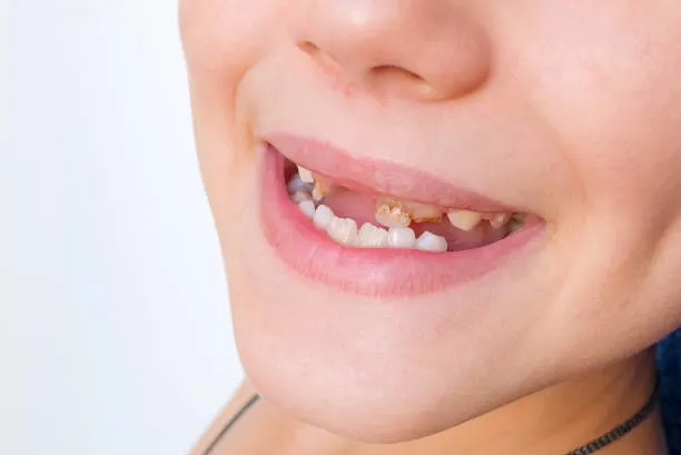 Intraoral Cameras