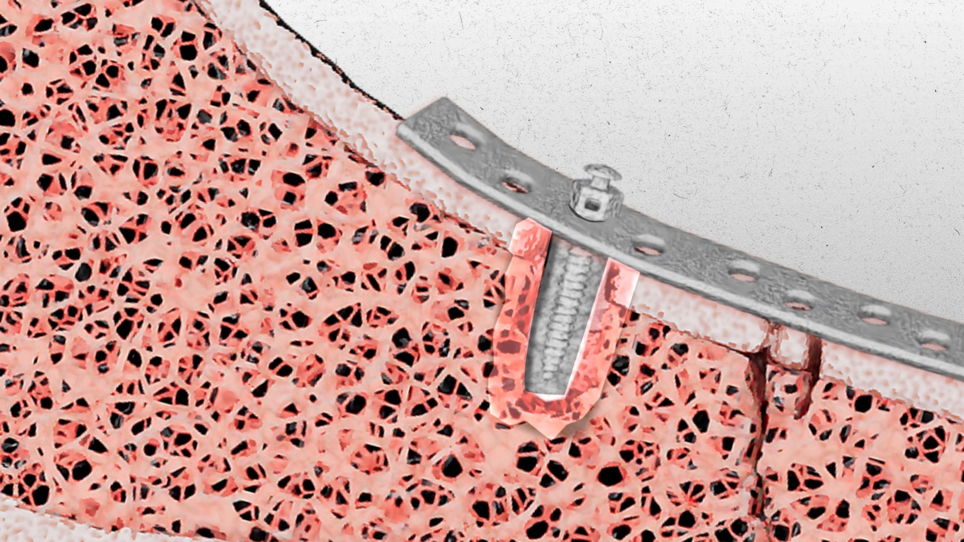 Gaps caused by poor integration between bone implants and human bone.