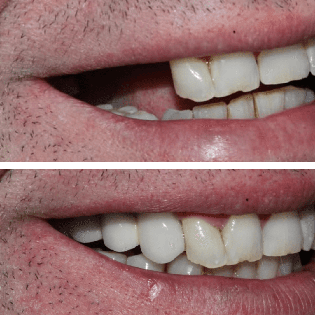 Restorative Dentistry at ScarboroSmiles Dental Clinic in Scarborough, ON | Best dentist in Scarborough. 