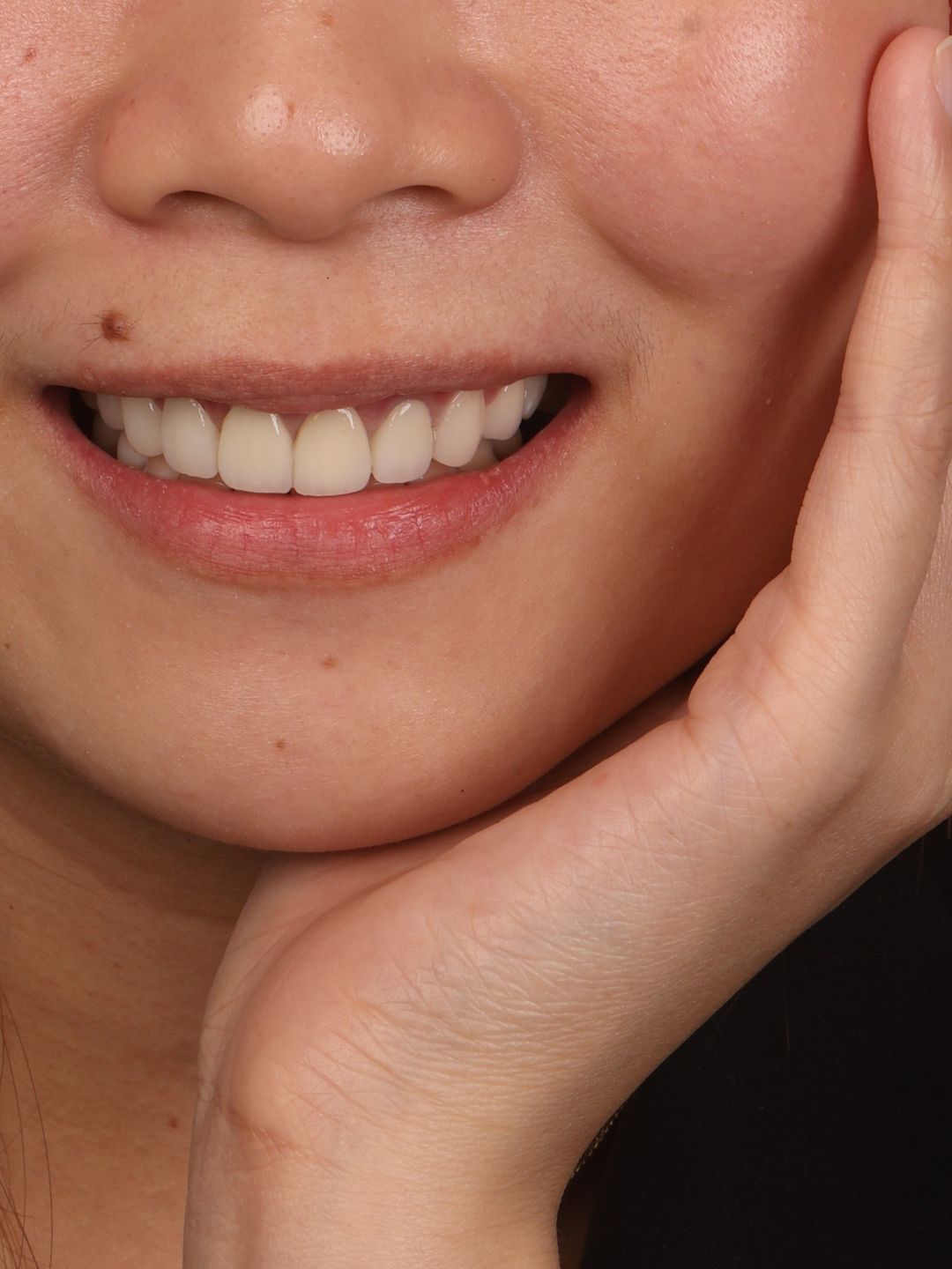 Patient smiling with natural-looking EMax crown and veneer results at Ora Dental Makati