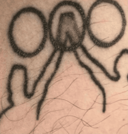 Geometric linework tattoo fading before five sessions of Toro laser tattoo removal.