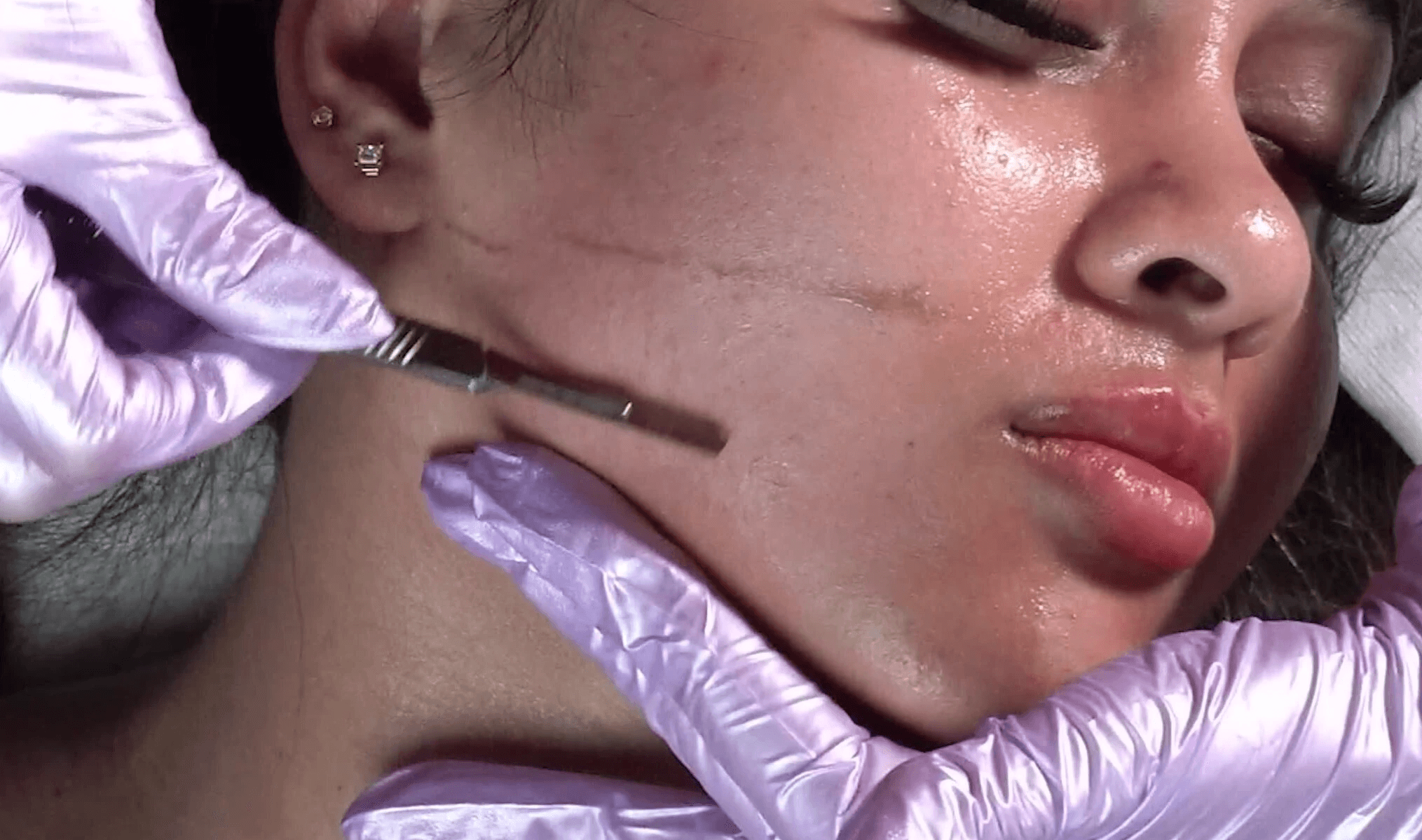 Dermaplaning pair with hydrafacial