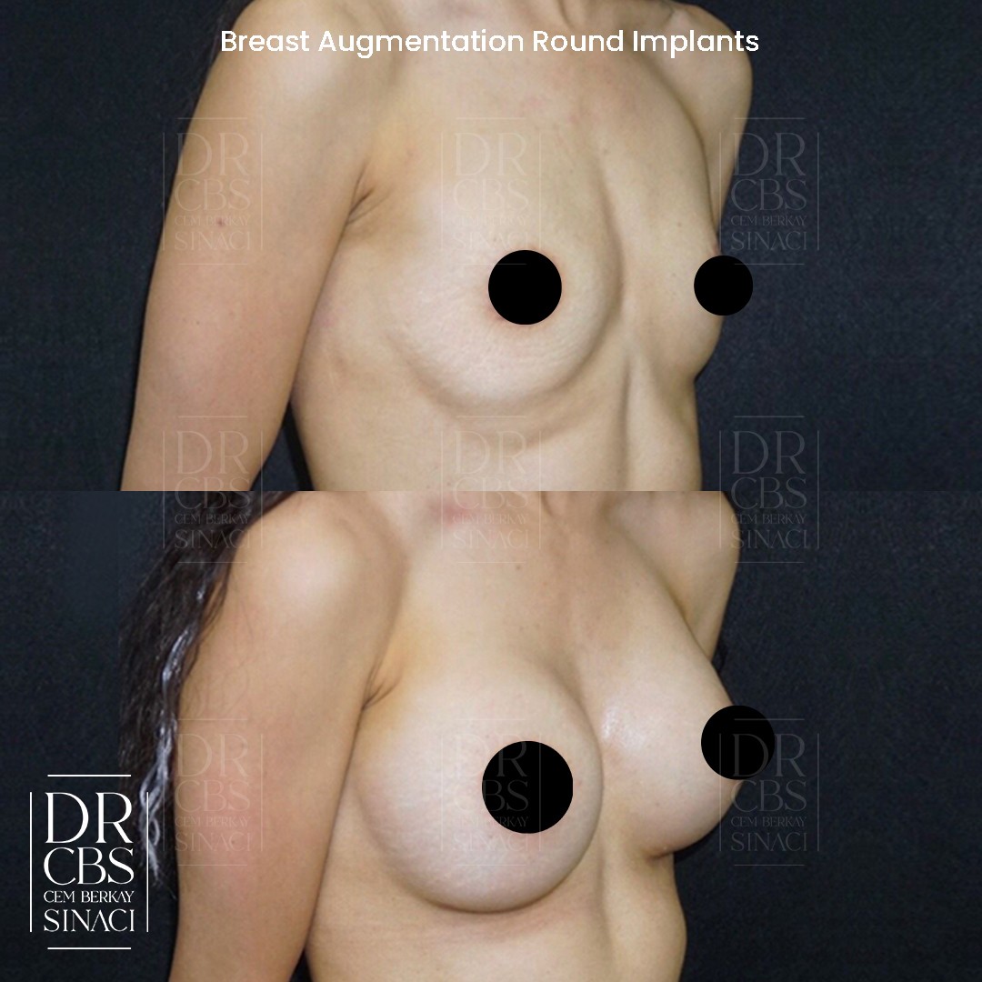 3 months breast implant dual plane before after oblique view