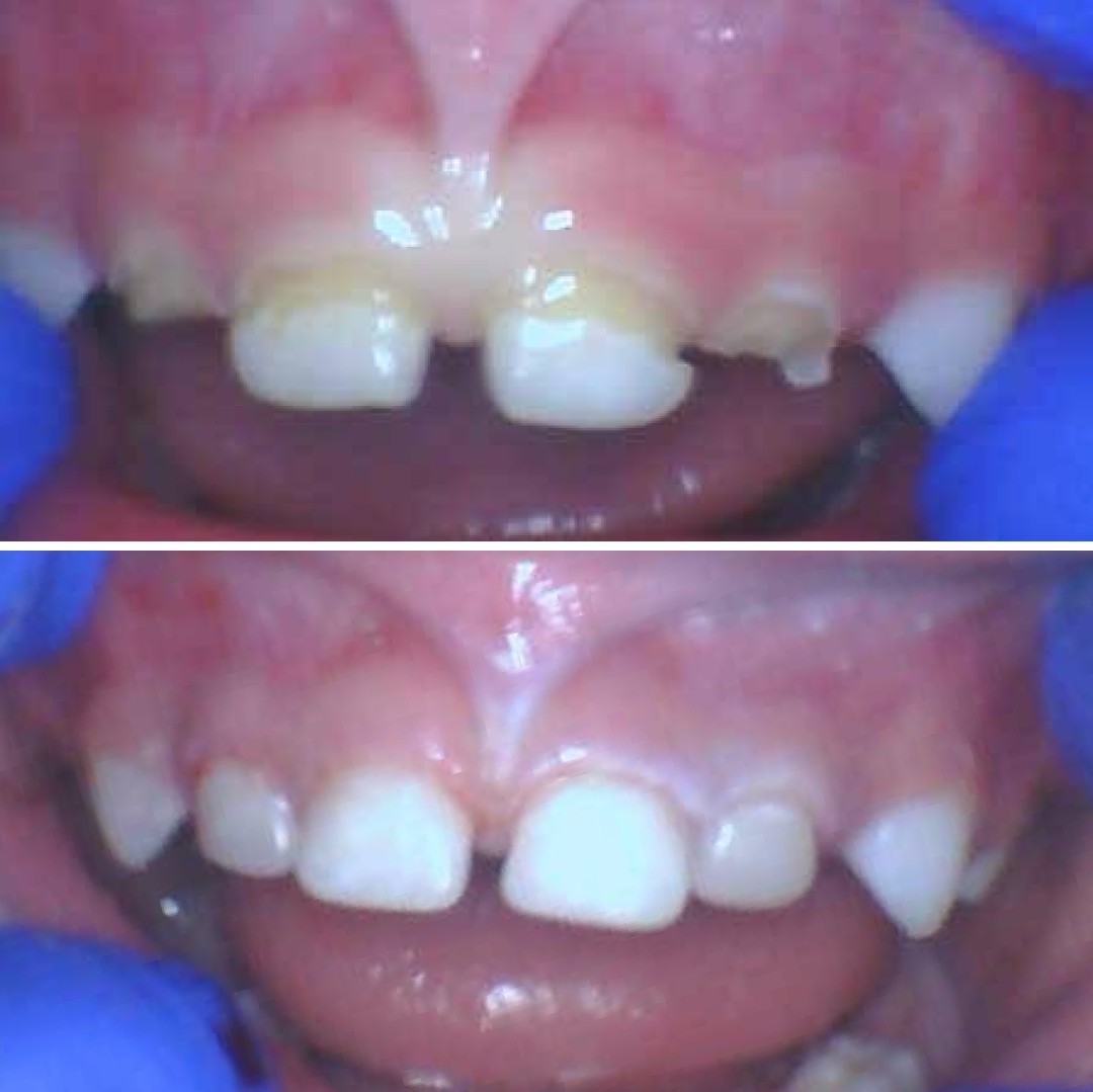 Before and after comparison of children's front teeth restored using the gentle, minimally invasive Atraumatic Restorative Technique.