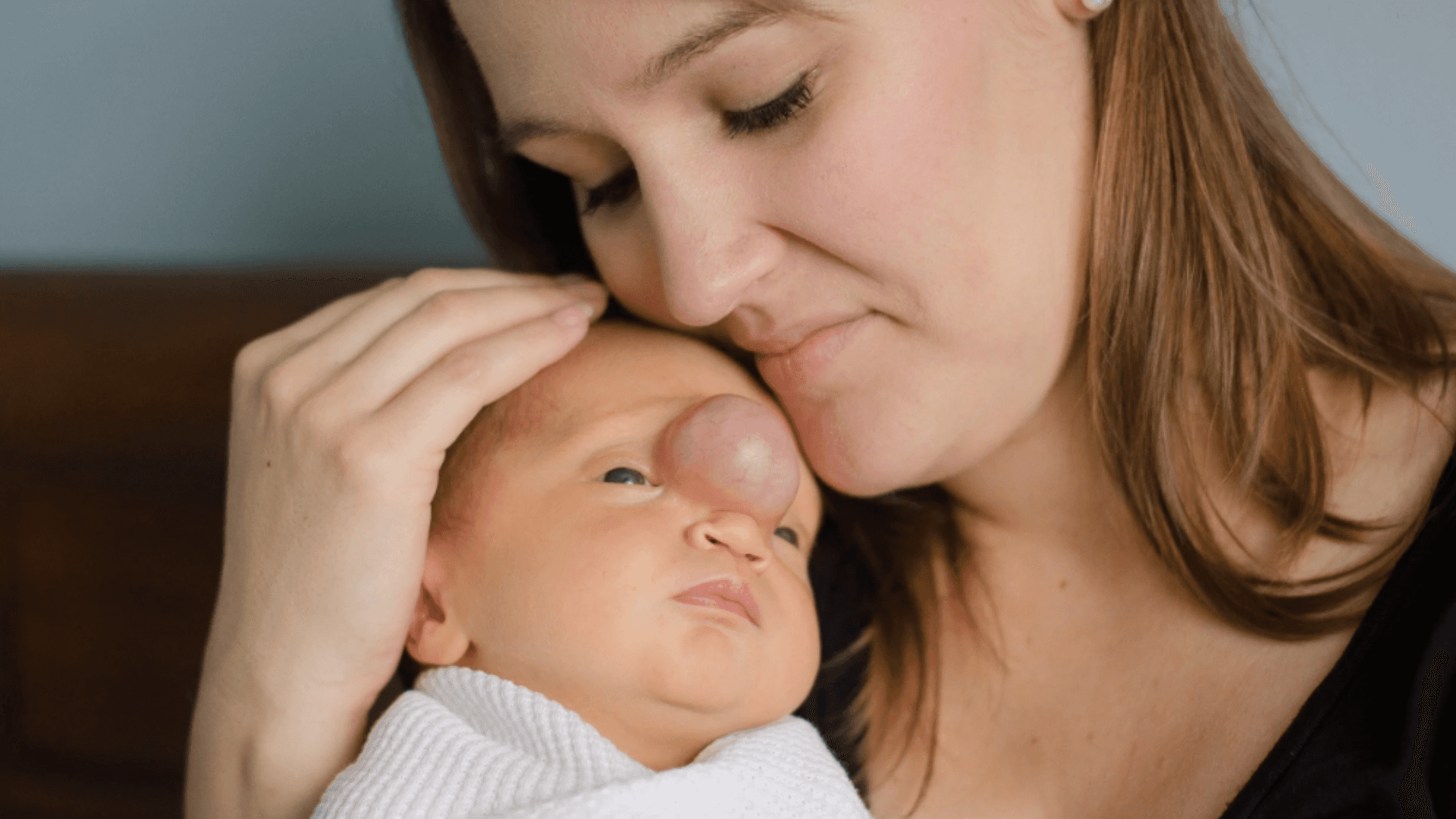 Mother gently cradles her baby, resting her forehead against the child’s head, as the baby looks up with a visible facial birthmark