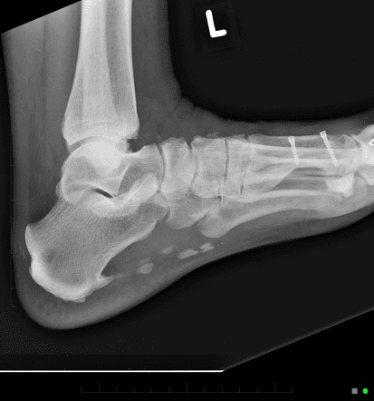 X-ray of Plantar Fascia Surgery