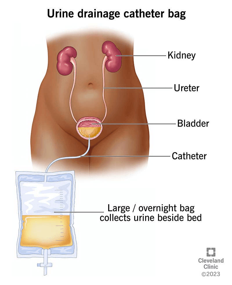 यह चित्र एक urine drainage catheter system का है जो post-operative recovery के लिए है, इसमें किडनी और bladder से होकर urine का flow एक overnight drainage bag में जाता है।