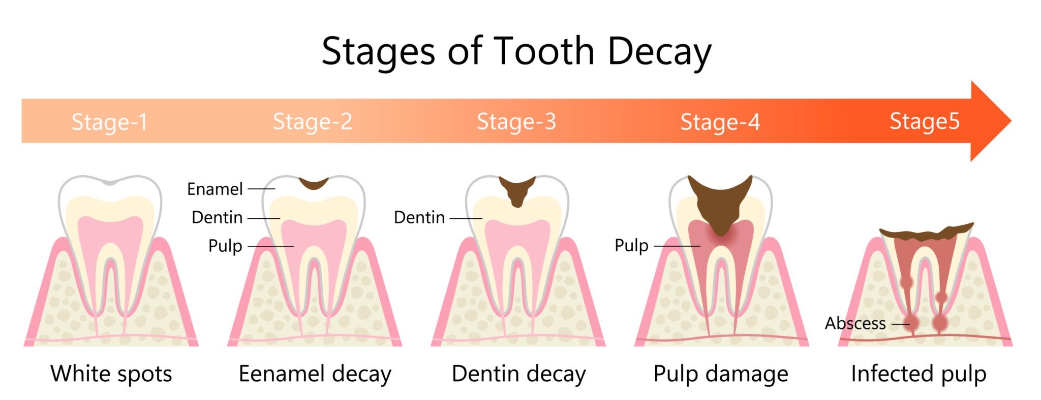 Image of a diagram showing the progression from a cavity to a dental abscess
