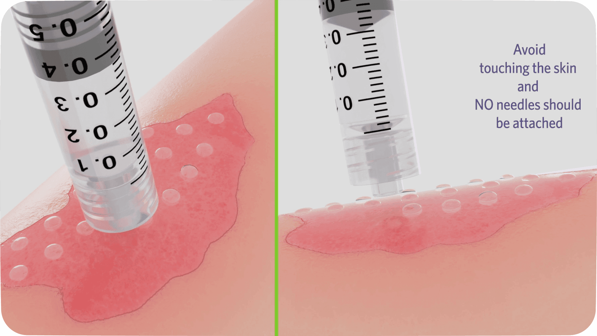 Side-by-side medical illustration showing a syringe positioned above irritated skin, with instructional text reading “Avoid touching the skin and no needles should be attached.”