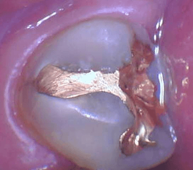 Tooth Color Posterior Filling - Before