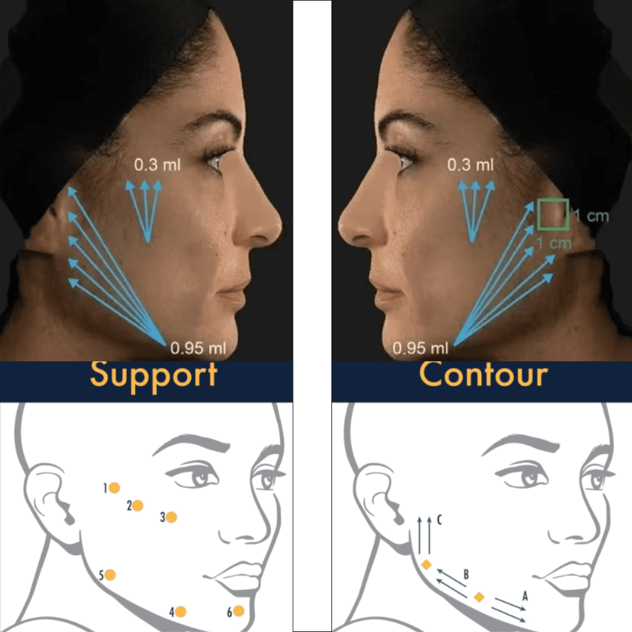 Hydroxyapatite Microsphere Facial Filler effectively smooths facial wrinkles and restores natural facial volume — professional manufacturer and supplier.