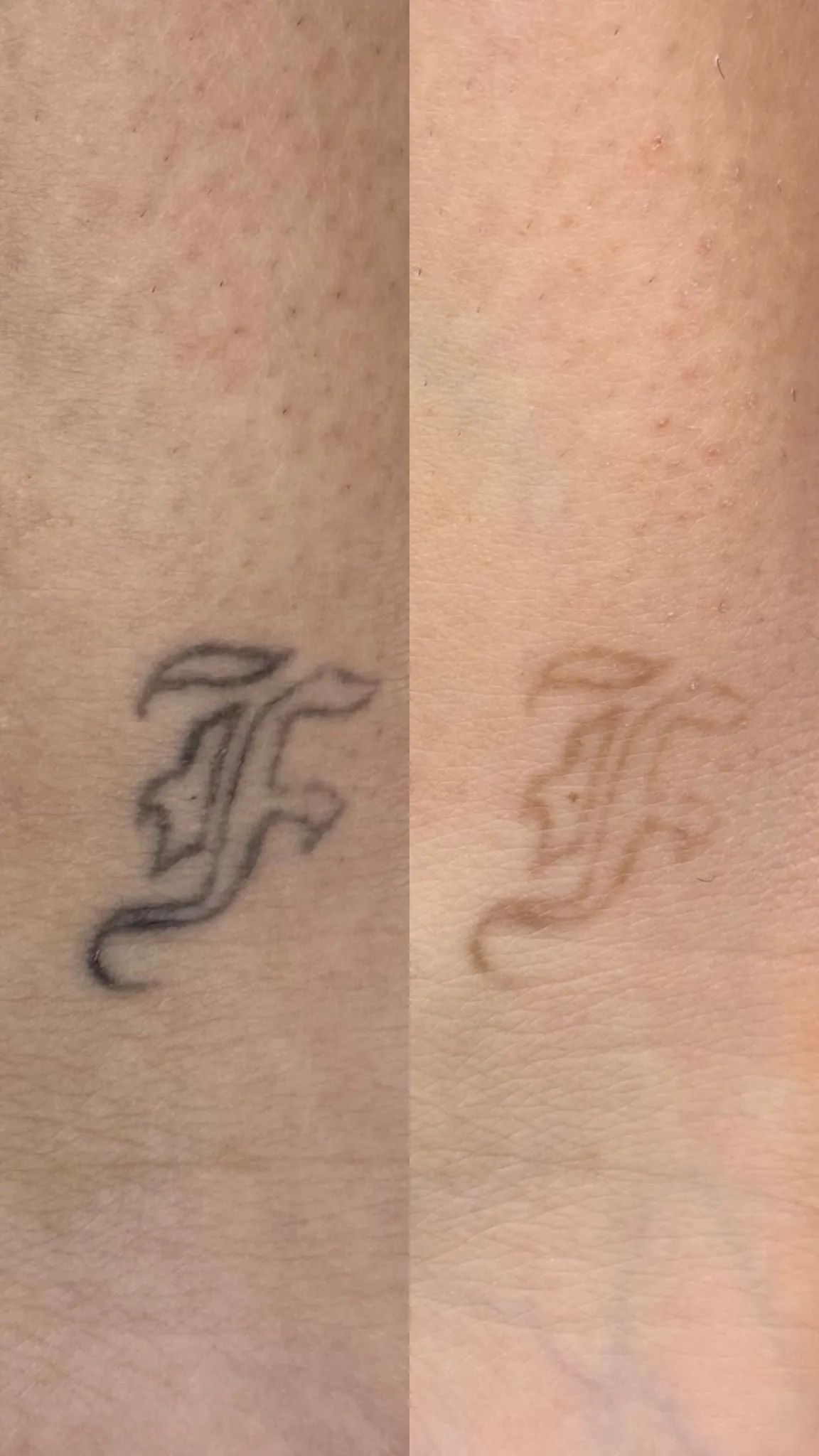 Sesión de láser para eliminar tatuaje en Móstoles