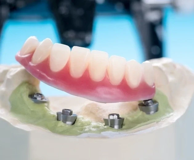 all-on-4 dental implants