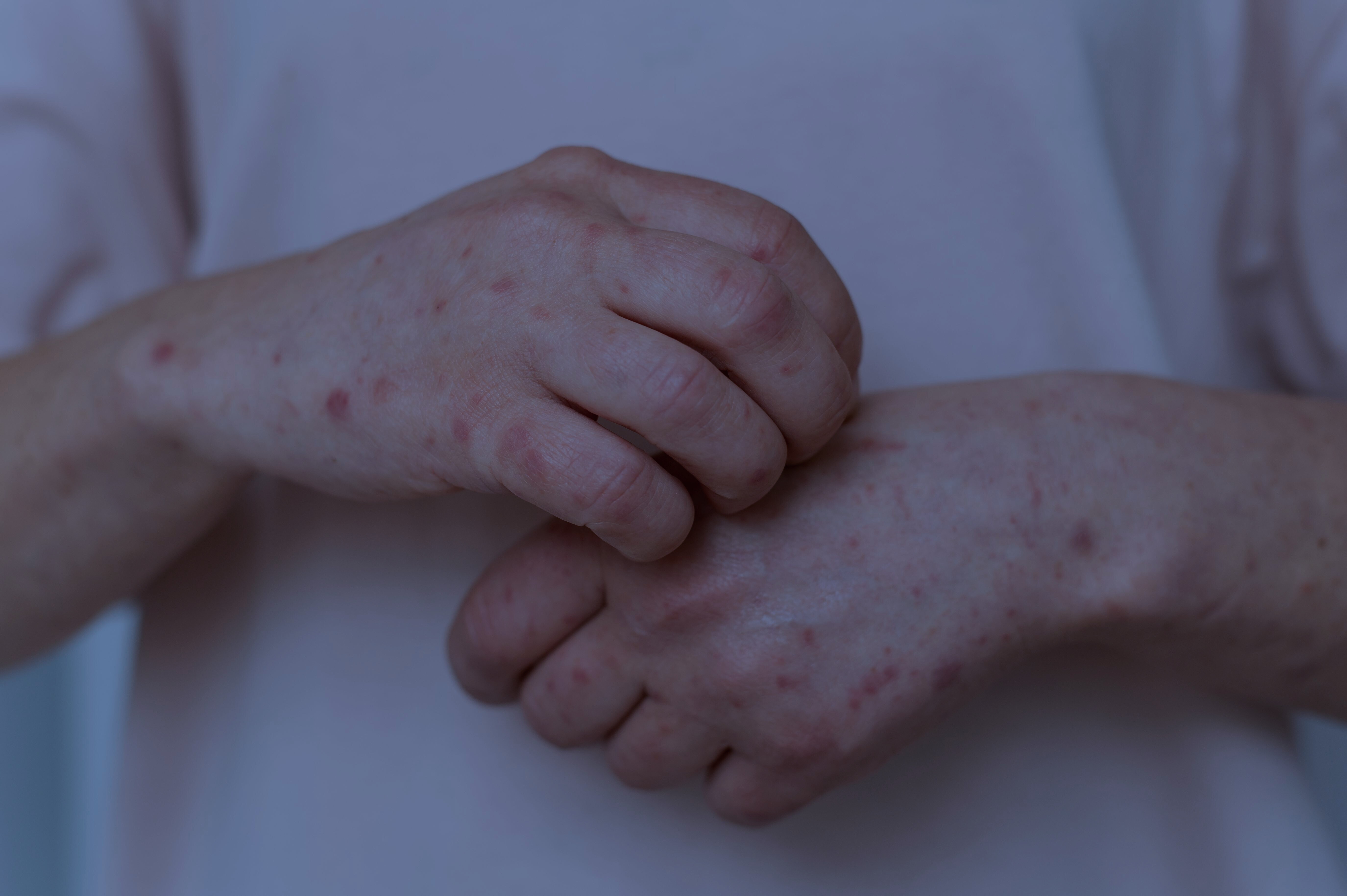impetigo treatment nairn
