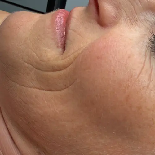 Before dermaplaning at The Vancouver Aesthetician — visible fine lines, wrinkles, and dull tired-looking skin