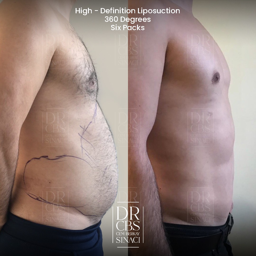 high-def liposuction before after 3 months post-op right side view