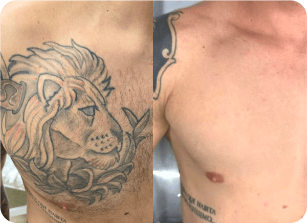 Imagem de antes e depois da remoção de tatuagem