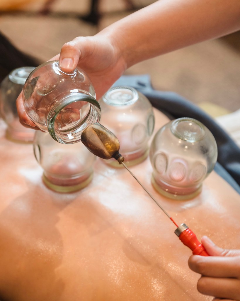 A person holds a glass cup used for cupping therapy, preparing to place it on a client's back, which has several other cups already positioned.